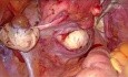 Miomas interligamentarios: abordaje laparoscópico 3D