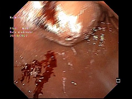 Lesión(es) submucosa gástrica y duodenal... ¿causan impresión?