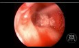 Resección de colesteatoma mediante abordaje endoscópico y microscópico