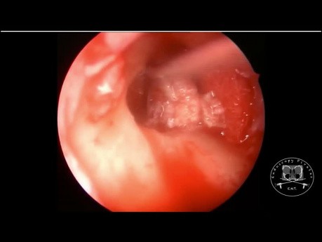 Resección de colesteatoma mediante abordaje endoscópico y microscópico