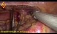 Esofagectomía toraco-laparoscópica - Parte torácica 3