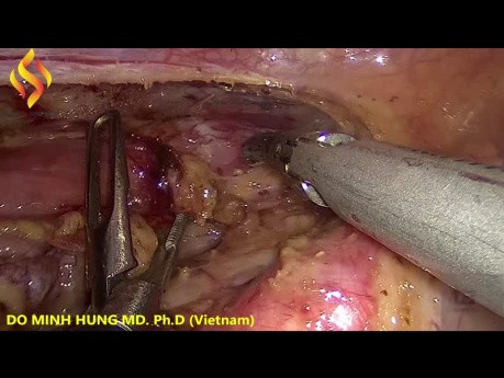 Esofagectomía toraco-laparoscópica - Parte torácica 3