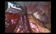 Gastrectomía total radical laparoscópica D2 para el cáncer gástrico