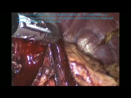 Gastrectomía total radical laparoscópica D2 para el cáncer gástrico