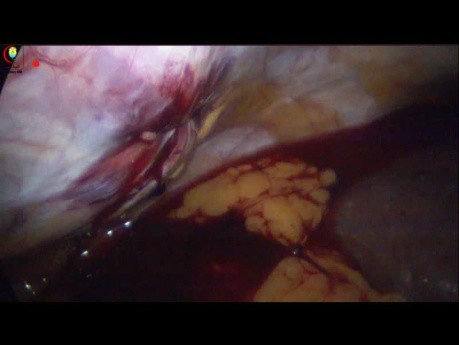 El cierre fascial de Nasr puede controlar el sangrado del sitio portuario