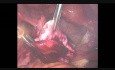 Cistadenoma ovárico