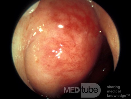 Carcinoma de nasofaringe