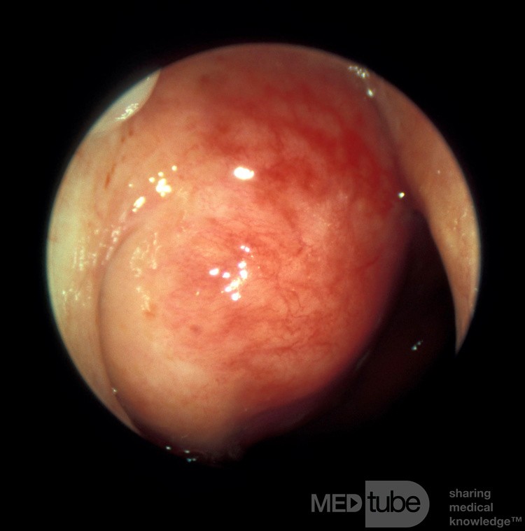 Carcinoma de nasofaringe