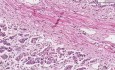 Histopatología de las glándulas suprarrenales - atrofia 