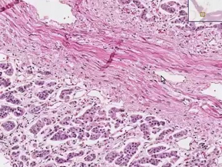 Histopatología de las glándulas suprarrenales - atrofia 