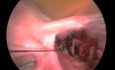 Miomectomía laparoscópica seguida de ligadura de arteria uterina