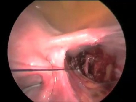 Miomectomía laparoscópica seguida de ligadura de arteria uterina