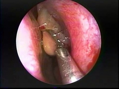 Polipectomía nasal - endoscopia