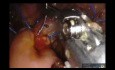 Pancreaticoduodenectomía robótica con colecistectomía para neoplasia pseudopapilar sólida