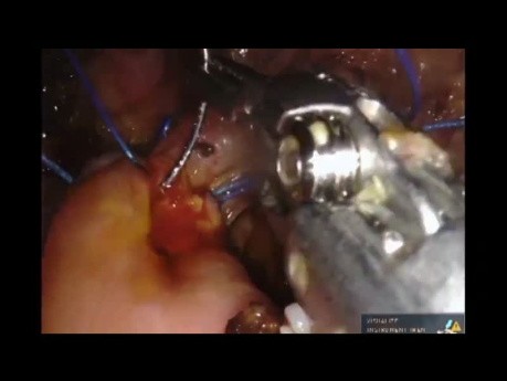 Pancreaticoduodenectomía robótica con colecistectomía para neoplasia pseudopapilar sólida