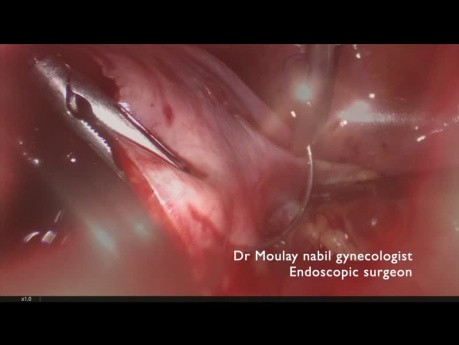 Mioma submucoso de 15 cm. Abordaje laparoscópico.