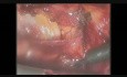 Reparación laparoscópica de hernia umbilical