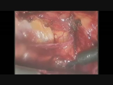 Reparación laparoscópica de hernia umbilical