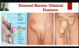 Hernia femoral/crural