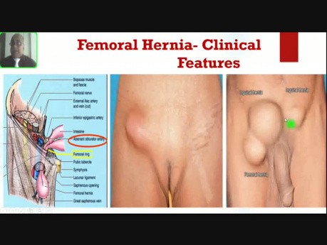 Hernia femoral/crural