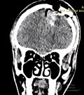 Estirpación de cavernoma subcortical 