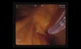 Duodenotomía y stent metálico autoexpandible (SEMS) biliar con colangiopancreatografía retrógrada endoscópica (CPRE)