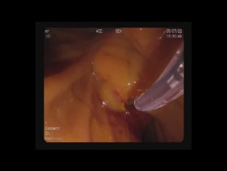 Duodenotomía y stent metálico autoexpandible (SEMS) biliar con colangiopancreatografía retrógrada endoscópica (CPRE)