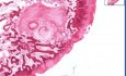 Oseoarthritis - torbiel podchrzęstna