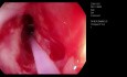 CRE Dilatación esofágica con balón - Ssgunda sesión