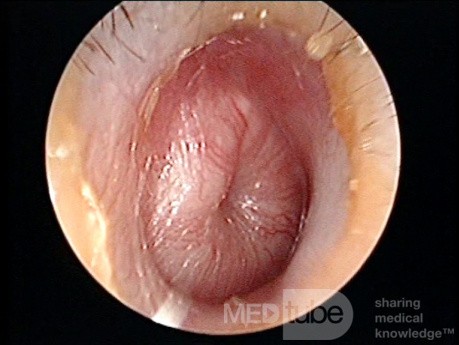 Otitis media aguda supurativa