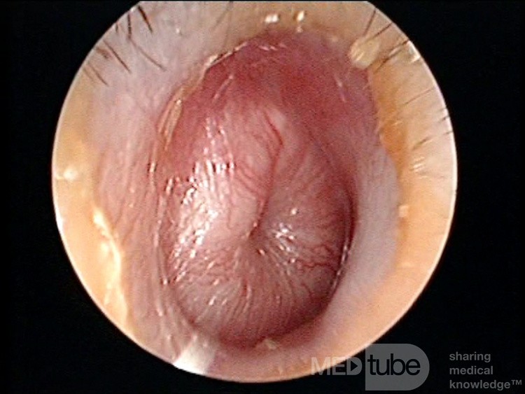 Otitis media aguda supurativa