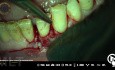 Laserterapia Microquirúrgica en Periodoncia