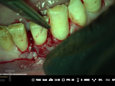 Laserterapia Microquirúrgica en Periodoncia