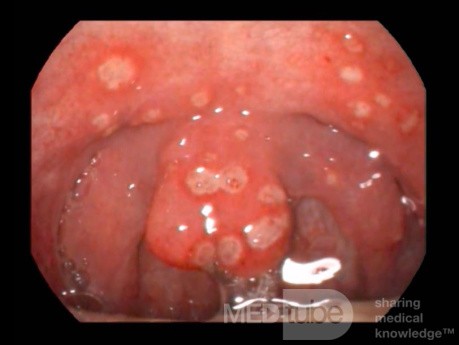 Úlceras de garganta