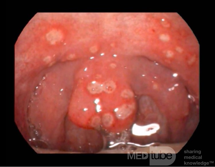 Úlceras de garganta