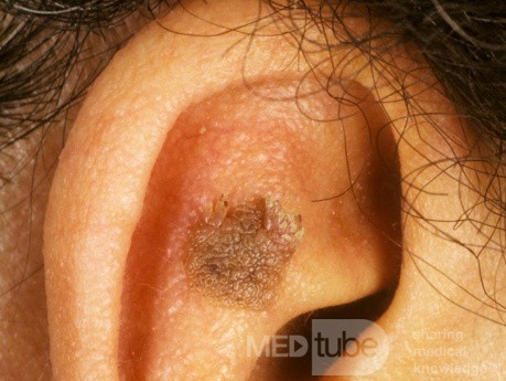 Queratosis seborreica