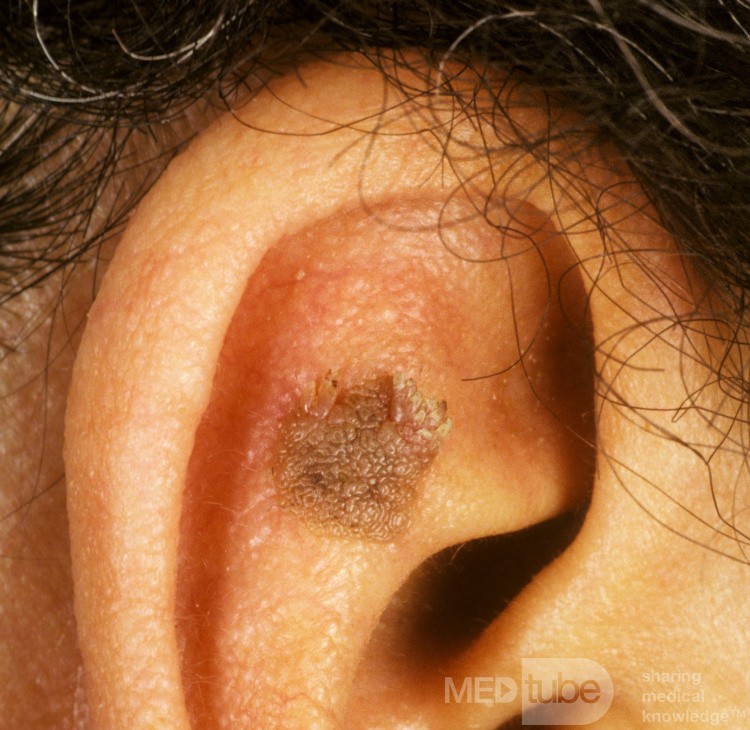 Queratosis seborreica
