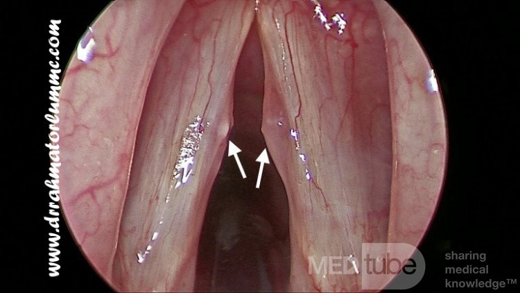 Pólipos bilaterales de las cuerdas vocales a consecuencia de fonotrauma repetido