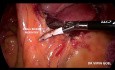 Hemicolectomía radical derecha laparoscópica con escisión mesocólica completa