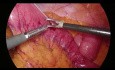 Yeyunostomía de alimentación laparoscópica