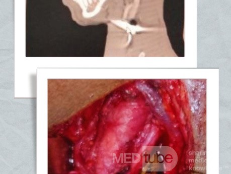 Herida de arma de fuego con citio de entrada en región mandibular derecha