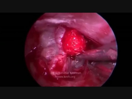 Abordaje endoscópico transcanal infracoclear (granuloma del ápice petroso)