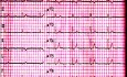 ECG Quiz 1. Un caso de electrocardiografía de un paciente con debilidad y mareos
