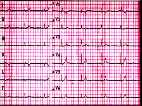 ECG Quiz 1. Un caso de electrocardiografía de un paciente con debilidad y mareos