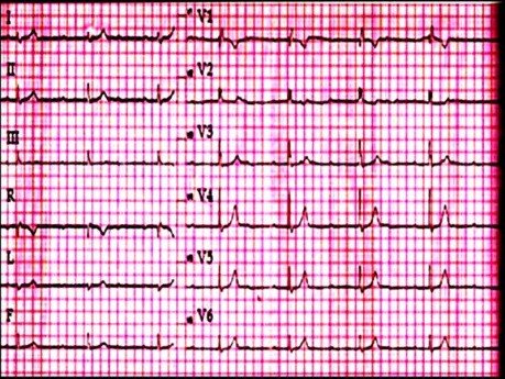ECG Quiz 1. Un caso de electrocardiografía de un paciente con debilidad y mareos