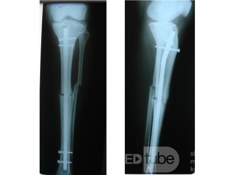 Clavo entrelazado intramedular de tibia