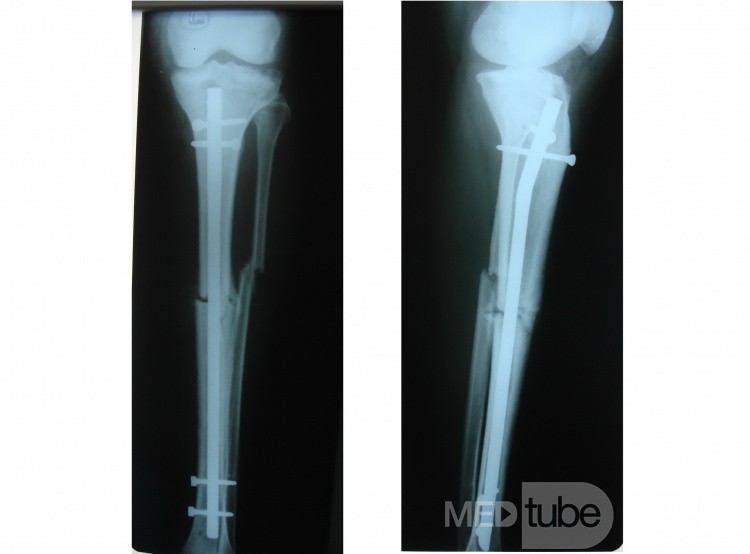 Clavo entrelazado intramedular de tibia