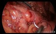 Pancreatoyeyunostomía longitudinal laparoscópica