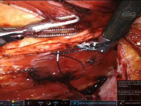 R-eTEP diástasis lateral de rectos & UH, Inan plicatura invertida