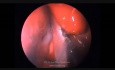 Extirpación endoscópica de fibroma juvenil 